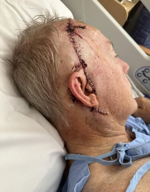 Coulton encourages sun safety following third melanoma removal