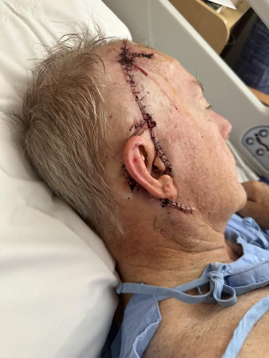 Coulton encourages sun safety following third melanoma removal